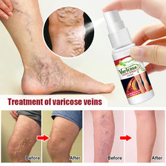 KanyeHB Vein Spray for Leg Care - 30ml